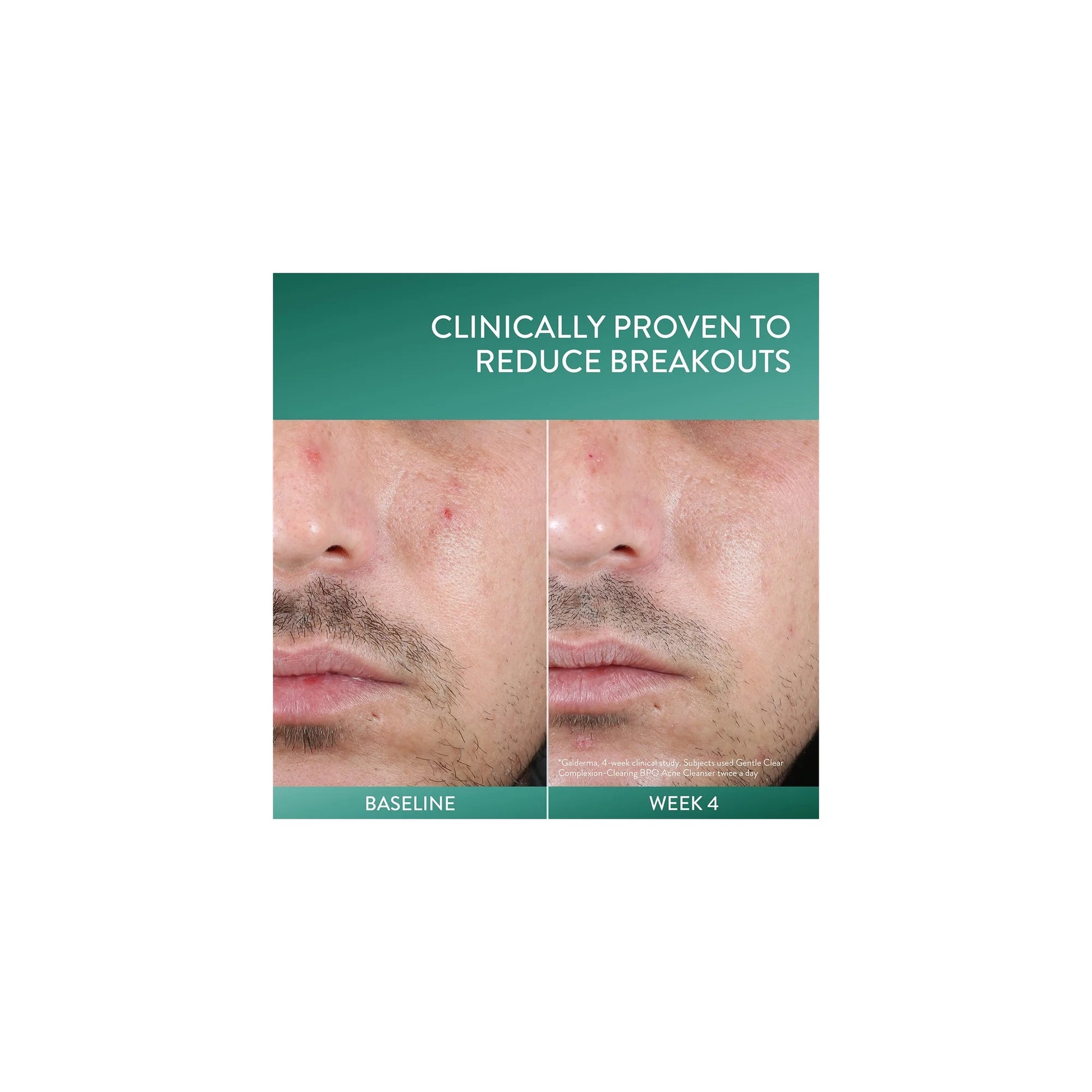 Gentle Clear Complexion-Clearing BPO Acne Cleanser, 4.2 Fl Oz (Pack of 3)