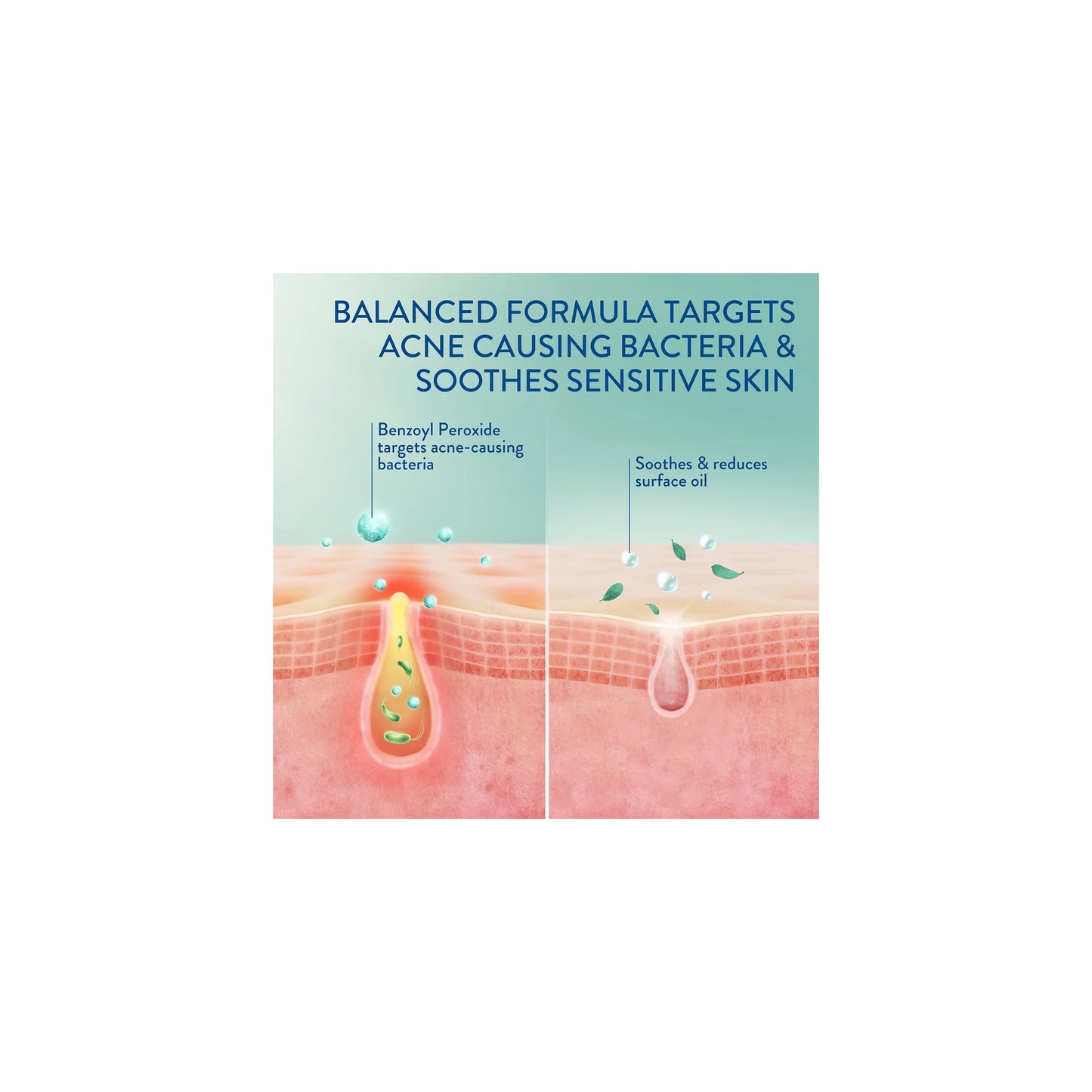 Gentle Clear Complexion-Clearing BPO Acne Cleanser, 4.2 Fl Oz (Pack of 3)